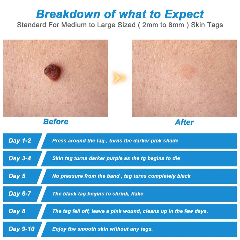 Auto Micro Skin Tag Remover
