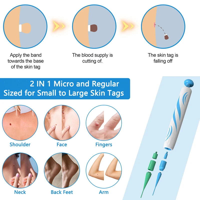 Auto Micro Skin Tag Remover