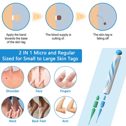Auto Micro Skin Tag Remover